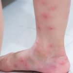 Fire ants' bites on a leg