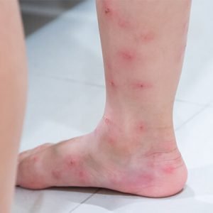 Ants bites on a girl's leg