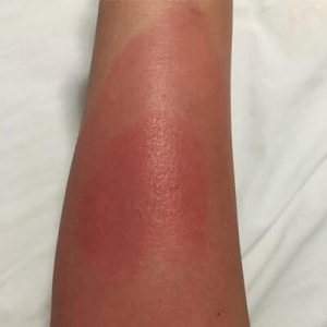 Bee sting allergic reaction