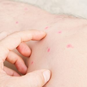 Flea bites on a man's legs