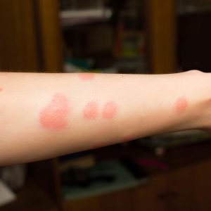 Flea bites on a woman's arm