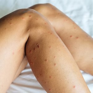 Fly bites on a woman's legs