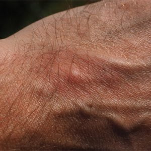 Mosquito bite on a man's hand