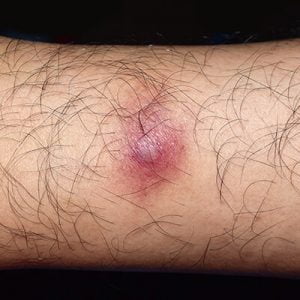 Mosquito bite with a Staphylococcal infection or cellulitis