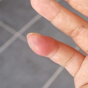 Spider bite on a woman's finger