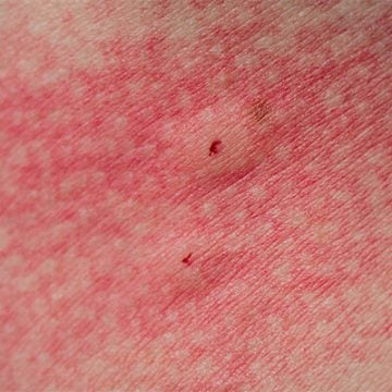 Spider Rashes What Bit You? Australian Insect Bites Identification