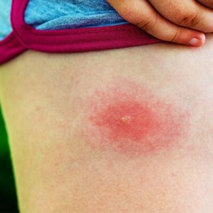 Tick bite on a child's leg