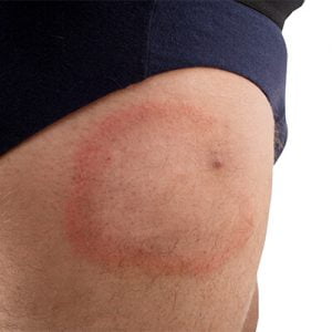 Tick bite on a man's leg