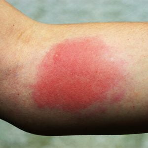 Wasp sting allergic reaction